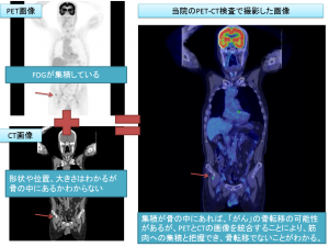 骨転移が疑われる症例