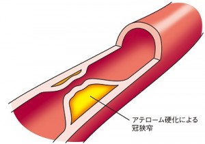 冠動脈狭窄症