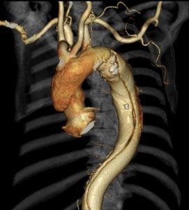 3D-CT：上行～下行大動脈にかけて解離