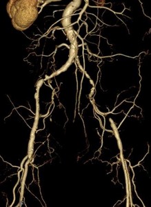 術前のCT画像。右腸骨(ちょうこつ)動脈狭窄及び左腸骨動脈閉塞を認めた