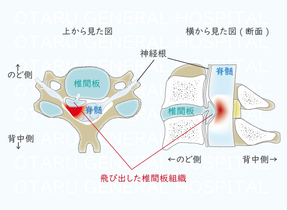 頚椎 椎間板 ヘルニア 仕事 休む