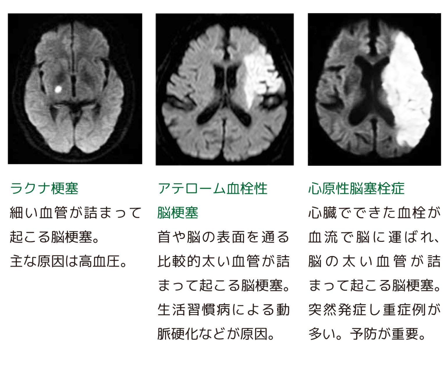 脳梗塞を発症しないために~「動脈硬化」を調べる検査「頸動脈エコー」 小樽市立病院 脳梗塞を発症しないために~「動脈硬化」を調べる検査「頸動脈エコー」 小樽市立病院
